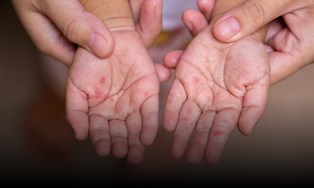 Coxsackie en México: El nuevo virus que ataca a niños; ¿cuáles son sus síntomas?