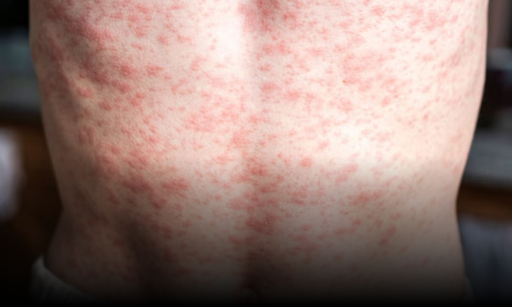 Brote de sarampión en México: qué es y cómo se contagia este virus que se creía casi extinto